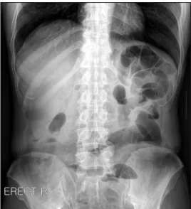 Fig. 1. Erect abdominal radiograph shows multiple dilated loops  predominantly on the left side of the abdomen.
