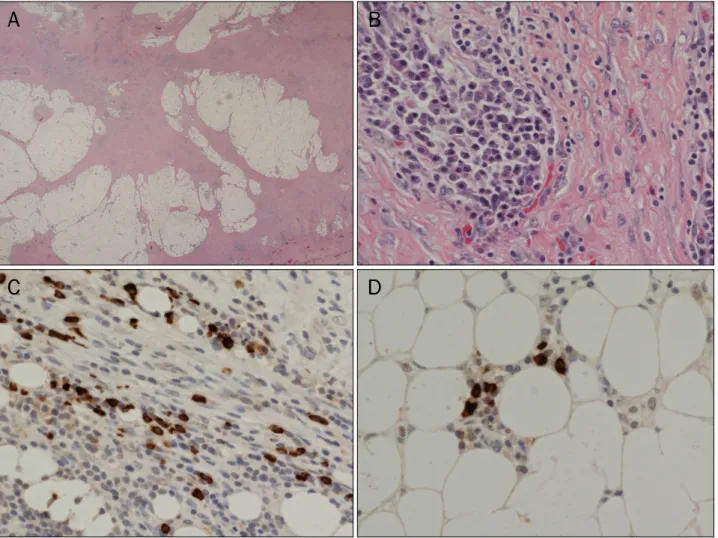 Fig. 2. Histologic findings of mesenteric mass. (A) Low magnification of mesenteric lesion shows marked fibrosis and inflammatory cell infiltration  (H&amp;E, ×10)