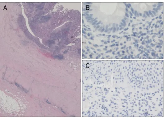 Fig. 3. Histologic findings of appendix  and urinary bladder. (A) Transmural  inflammation and small noncaseating granulomas are seen in the  appendi-ceal mucosa (H&amp;E, ×20)