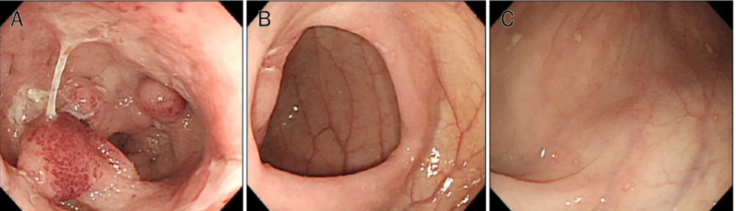 Fig. 7. Follow-up colonoscopic findings. Multiple variable sized ulcers with polypoid lesions are noted at terminal ileum (A) and ileocecal valve (B)