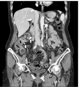 Fig. 2. Abdominal CT shows colonic wall thickenings accompanied by mural and mesenteric venous calcifications in the ascending colon  (arrows).