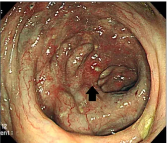 Fig. 4. Microscopic examinations. Marked thickening and calcifications of the colonic mucosal and submucosal layers are noted
