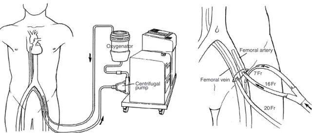 Figure 2. Diagram of percutaneous cardiopulmonary support system (PCPS; EBS Capiox, Terumo, Japan)