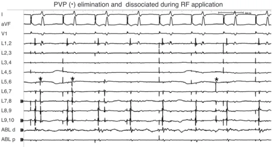 Figure 2. Dissociated pulmonary vein potential (PVP, *) from the let atrium after ablation