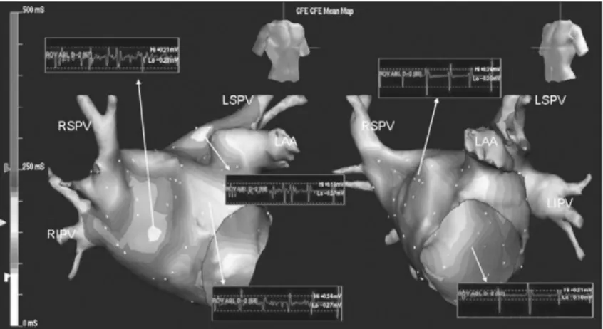 Figure 7. Automated map of complex fractionated atrial electrograms (CFAEs) during atrial fibrillation (6 seconds segment)