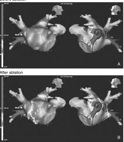 Figure 8. Linear ablation along the complex fractionated atrial electrograms (CFAEs, white color denotes cycle length <120ms) during atrial fibrillation