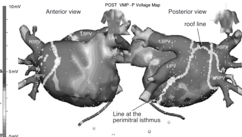 Figure 9. Voltage map after isolation of 4 pulmonary veins and linear ablation at the roof and perimitral isthmus in patients with chronic, persistent atrial fibrillation