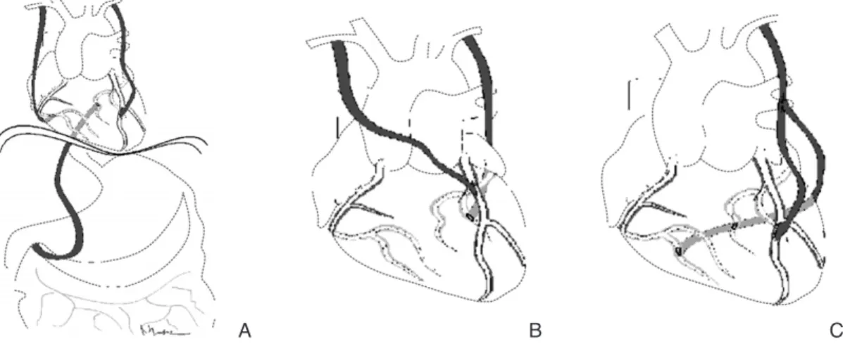 Figure 1. Variable techniques of total arterial revascularization.
