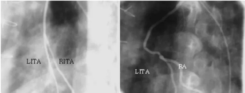 Figure 3. Composite graft LITA with RITA, or LITA with radial artery. 