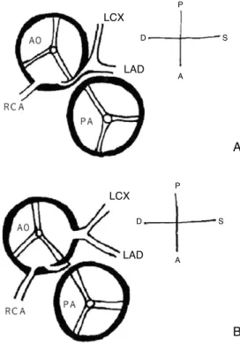 Figure 5. Reimplantation technique of Left coronary artery to left coronary sinus (26)