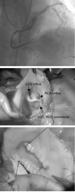 Figure 6. Unroofing of intramural right coronary artery in the aorta.