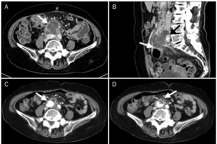 Fig. 1. Contrast-enhanced CT scans. (A) Low density lesion measuring approximately 5.2 cm in size (arrow) with peripheral enhancement was  observed anterior to the aortic bifurcation without aortic aneurysm on an initial CT scan