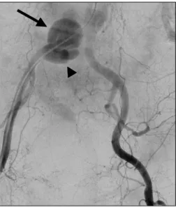 Fig. 3. After massive bleeding, emergency aortography was  performed. It showed a known aneurysm measuring approximately 2 cm size (arrowhead) and a newly developed aortic aneurysm  measuring approximately 5 cm in size (arrow) at the right common iliac art