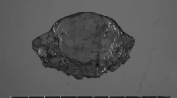 Figure 1. Surgical resection of hepatocellular carcinoma.  