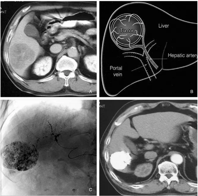 Figure 2. Transcatheter arterial chemoembolization. 