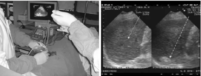Figure 3. Photograph during the Ethanol Injection. The echogenicity of targeted mass is increased after injection of ethanol