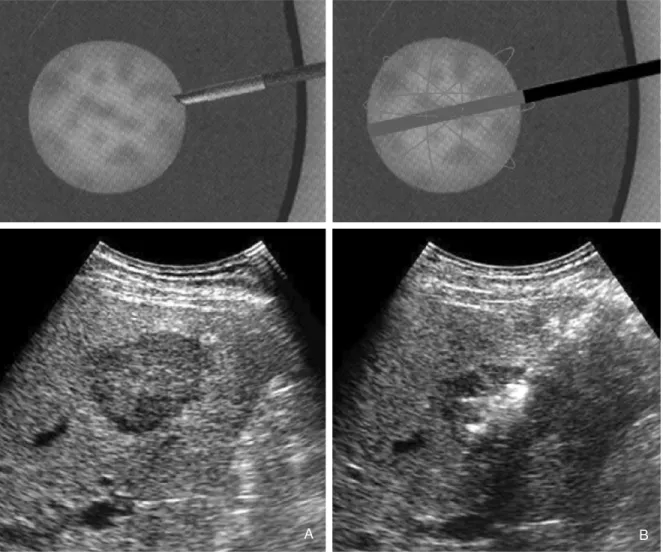 Figure 4. Radiofrequency ablation. 