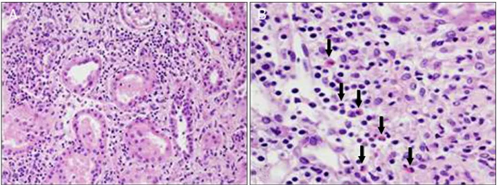 Fig. 2. Histologic examination with light microscopy of kidney. (A) There was diffuse tubular damage and infiltration of interstitial inflammation  into the tubular epithelial cells (H&amp;E, ×100)