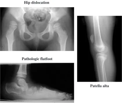 Figure 1. Lever-arm dysfunctions at the hip, knee, and the foot produce hip dislocation, patellar alta, and pathologic flatfoot, respectively