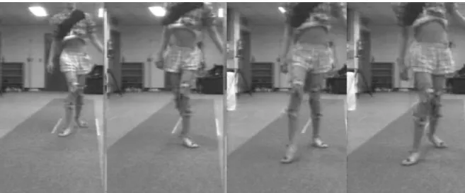 Figure 9. Planovalgus foot deformity.