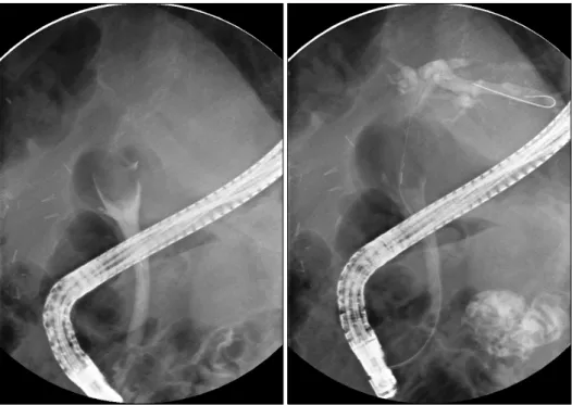Fig. 1. Coronal view of the CT scan shows a well enhancing tumor in the common bile duct (arrow).