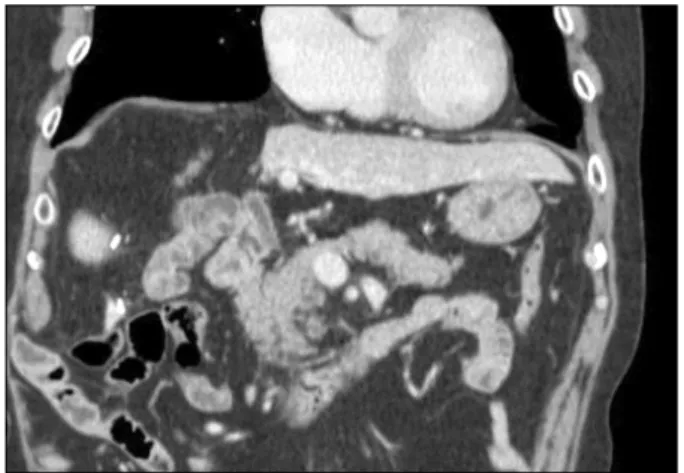 Fig. 4. Coronal view of the follow-up CT scan shows disappearance  of common bile duct tumor after endoscopic retrograde biliary  drainage removal
