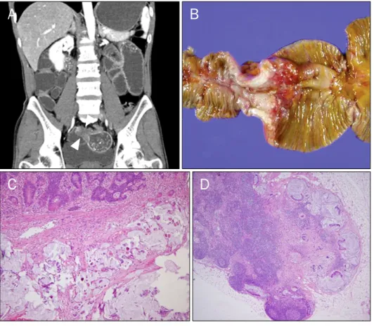 Fig. 2. Endoscopic findings. Multiple  nodular lesions with erosion are seen in the stomach (A) and duodenum (B)