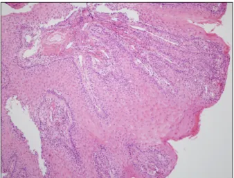 Fig. 3. Histological view of the esophageal mucosal lesion showing prominent hyperplasia of the epithelium (H&amp;E, ×100).