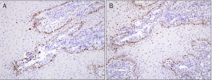 Fig. 4. Immunohistochemical view of the esophageal mucosal lesion showing staining limited to the basal layer of benign epithelium with: (A) Ki67 immunostain (×200); (B) p53 immunostain (×200).