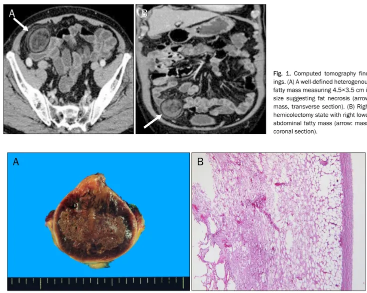 Fig. 1.  Computed  tomography  find- find-ings. (A) A well-defined heterogenous  fatty mass measuring 4.5×3.5 cm in  size suggesting fat necrosis (arrow: 