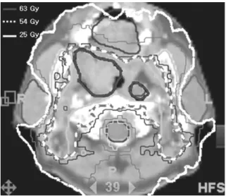 Figure 2. Tomotherapy plan for tonsillar cancer.
