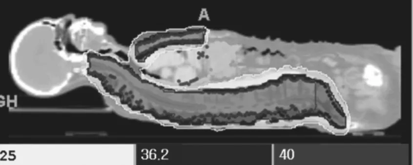 Figure 6. Tomotherapy planning in a complicated case of multiple metastases including sternum and the whole spine.