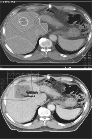 Figure 1. Dose distribution of proton beam and x-ray.    