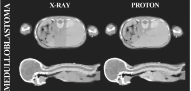 Figure 3. Comparison between conventional x-ray therapy and proton therapy for whole spinal irradiation
