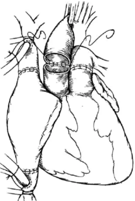 Figure 3. Bicaval technique of Orthotopic heart transplantation.