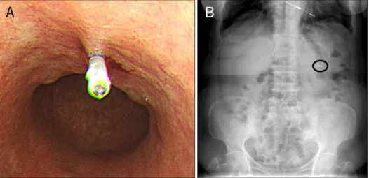 Fig. 1. Pre-operative endoscopic clipp- clipp-ing for early gastric cancer (HX-600-  090L Ⓡ ; Olympus)