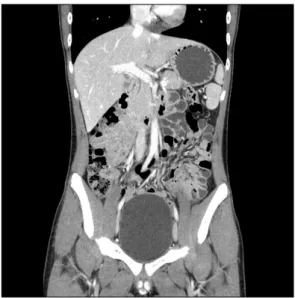 Fig. 1. Preoperative abdominal CT scan (coronal image) shows a tiny hepatic cyst in S5 and no abnormalities in the small bowel.