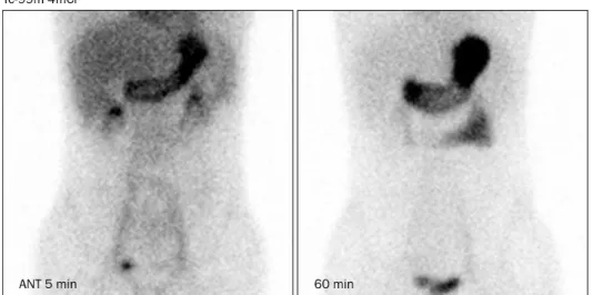 Fig. 4. Small bowel follow-through shows blind-ending diverticulum  (arrows) with hemoclips.