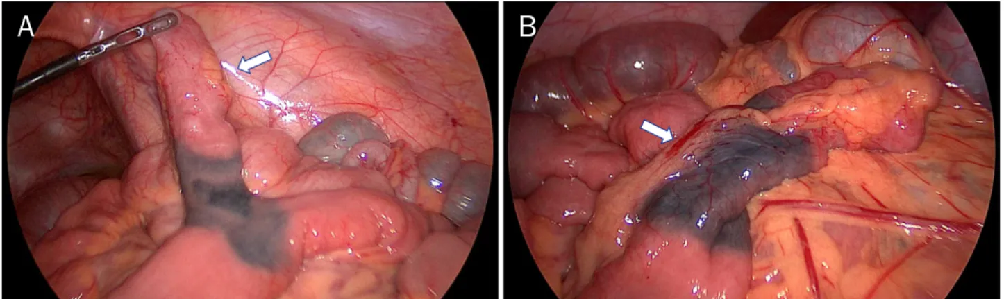 Fig. 5. Laparoscopic operative findings. (A) About 5 cm sized diverticulum which had been marked with tattoo (arrow) is visible