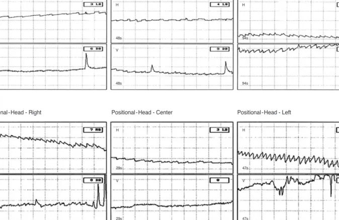 Figure 1. The results of positional test. It shows two types of horizontal canal benign positional paroxysmal vertigo
