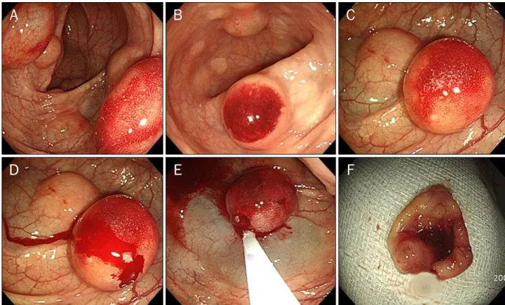 Fig. 1. Index colonoscopic findings. (A , B) Multiple submucosal tumors are observed between 20 cm and 40 cm from the anal verge