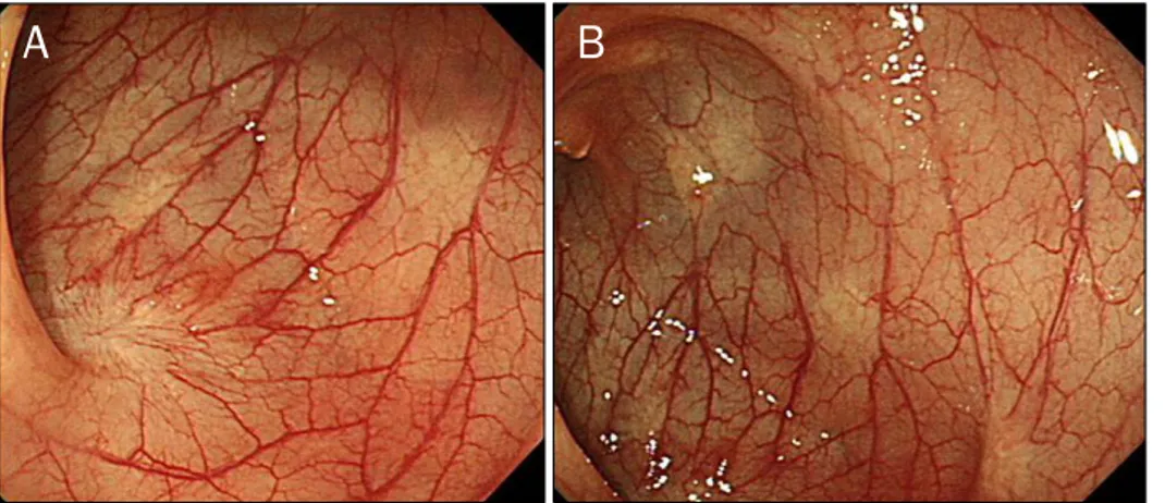 Fig. 4. Findings of the second colonoscopic examination performed 6 months after the index colonoscopy