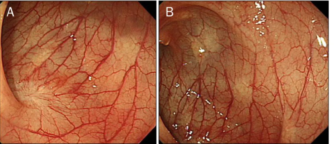 Fig. 4. Findings of the second colonoscopic examination performed 6 months after the index colonoscopy