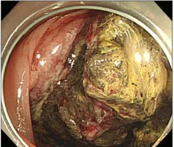 Fig. 2. Endoscopic finding. A large fungating mass is seen on distal ascending colon which almost obstructs the bowel lumen.