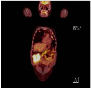 Fig. 4. PET scan finding. The mass at hepatic flexure shows intense hypermetabolism with standardized uptake value of 10.8.