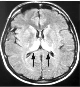 Figure 4. A Pulvinar sign (arrows) of variant Creutzfeldt - Jakob disease (MR flair image) (from internet).