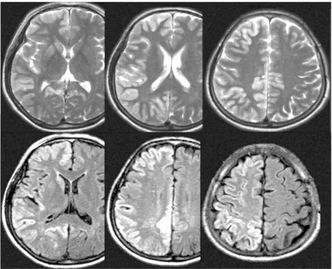 Figure 2. Diffusion weighted images (lower line) of sporadic Creutzfeldt-Jakob disease show asymmetrical high signal intensities along the gyrus, which were not so clear in T2W images (upper line).
