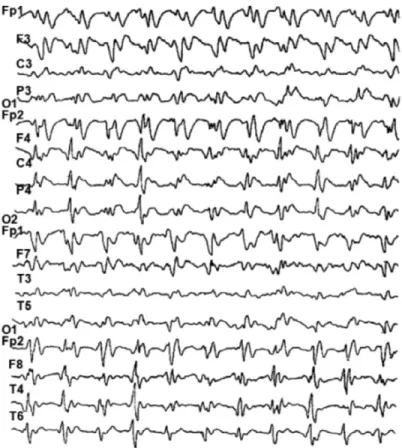 Figure 3. Periodic sharp waves at about 1.5/sec; diffuse, bilateral, slightly asym- asym-metrical: and maximal over the anterior portions of the brain.