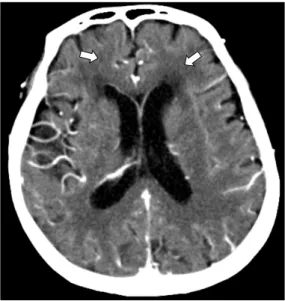 Fig. 2. India ink stain for Cryptococcus neoformans in the  cerebrospinal fluid (×400).환  동반  시  간성  뇌증이  흔하므로  의식저하,  두통,  구토,  퍼덕떨림,  유두부종  등의  신경학적  이상  소견  있을  시  기회감염에 의한  뇌수막염에  대해  염두에  두고  조기  뇌척수액  검사를  고려하고  조기치료를  시작해야  한다.저자들은  발열과  의식  저하를  주소