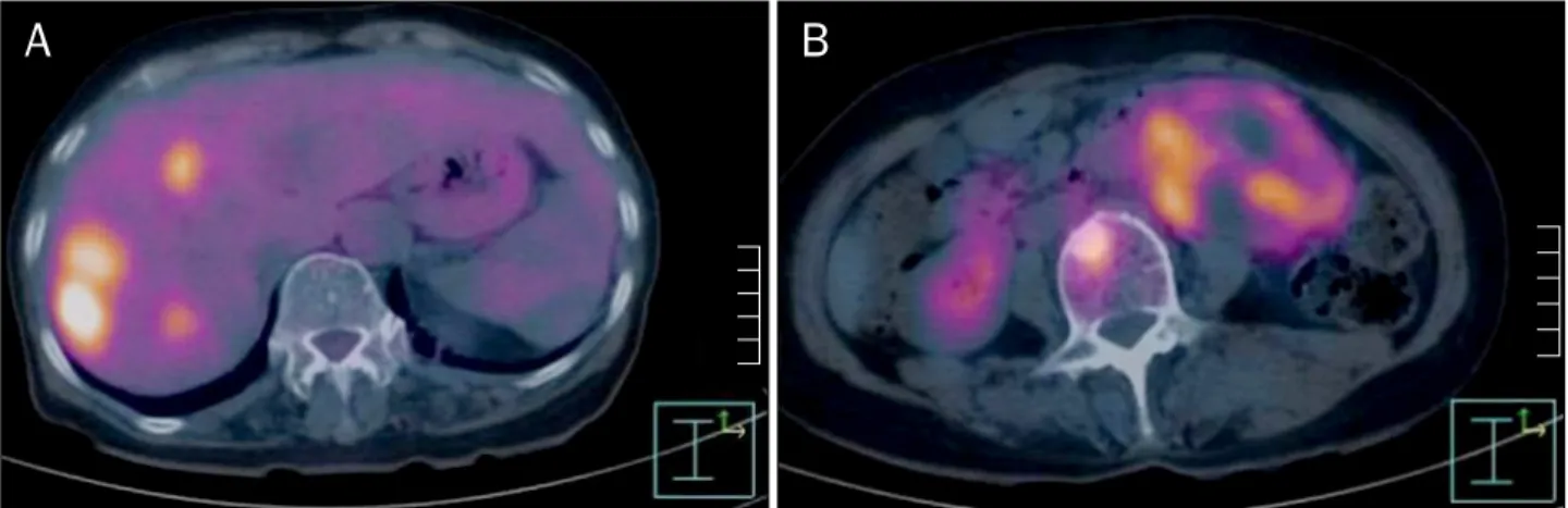 Fig. 1. Abdominal enhanced computer tomography shows multiple hypervascular nodules in the liver (A) and 9 cm sized heterogenous enhancing  mass in left para-aortic space (B).